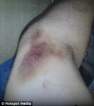 One of many bruises on victim