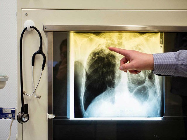 tuberculosis-x-ray-medical-ap-640x480