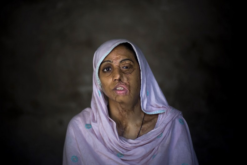 Shameem Akhter, 18, poses for a photograph at her home in Jhang, Pakistan. Shameem was raped by three boys who then threw acid on her three years ago. Shameem has undergone plastic surgery 10 times to try to recover from her scars. (AP Photo/Emilio Morenatti)