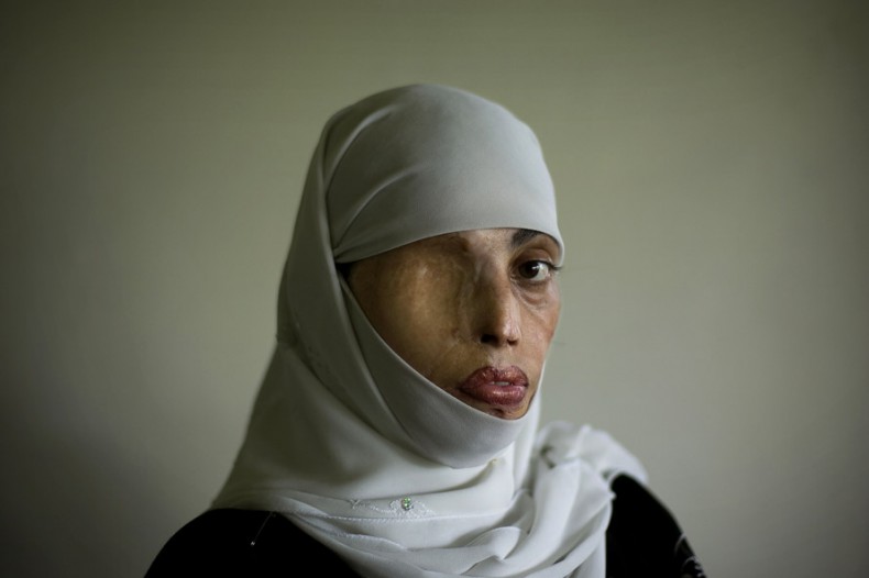 Irum Saeed, 30, poses for a photograph at her office at the Urdu University of Islamabad, Pakistan, Thursday, July 24, 2008. Irum was burnt on her face, back and shoulders twelve years ago when a boy whom she rejected for marriage threw acid on her in the middle of the street. She has undergone plastic surgery 25 times to try to recover from her scars. (AP Photo/Emilio Morenatti)